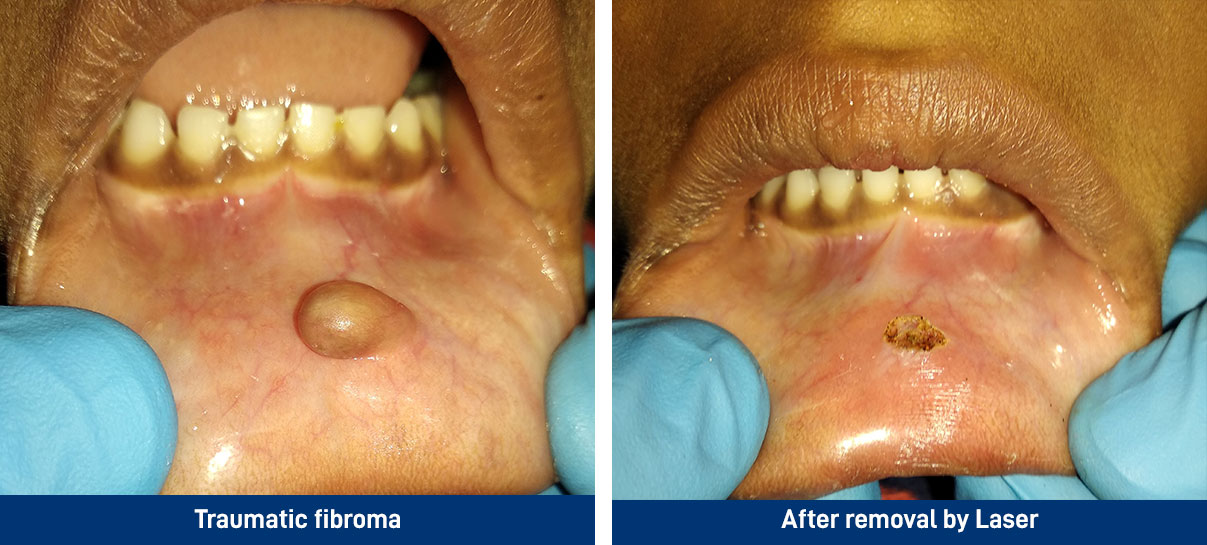 Traumatic fibroma
