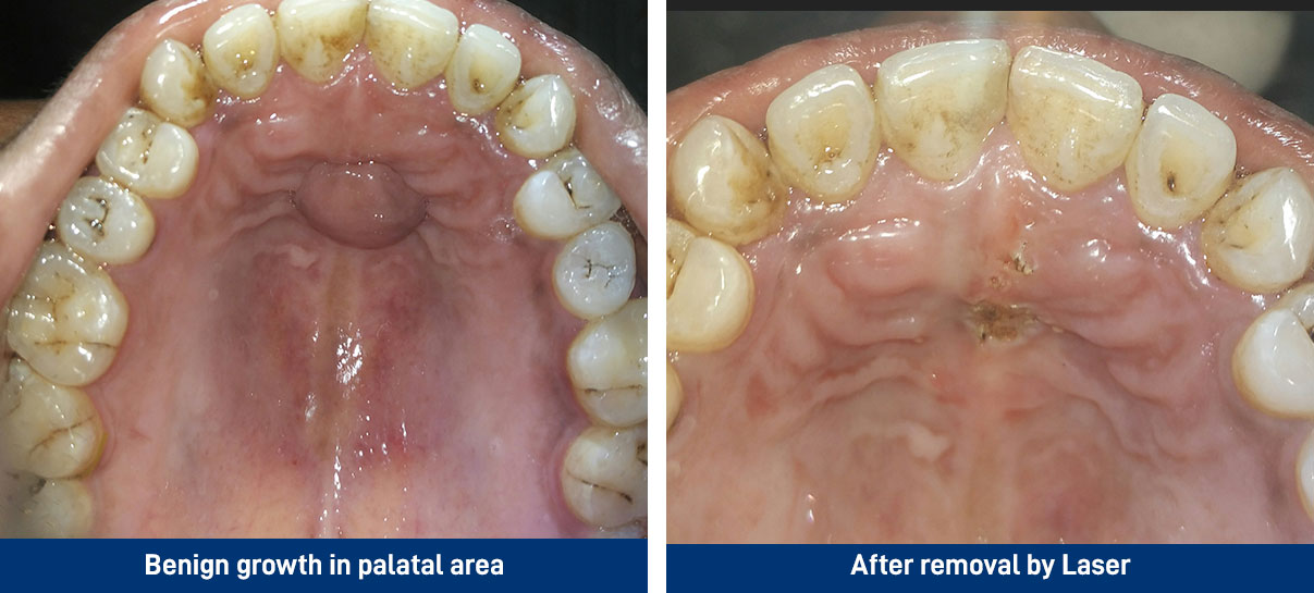 Benign growth in palatal area