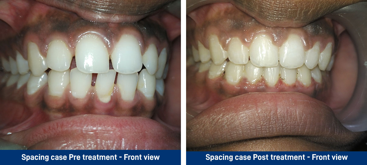 Spacing case Pre treatment