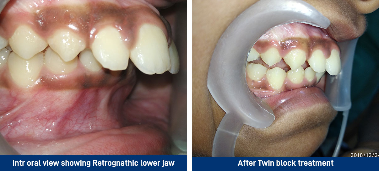 After Twin block treatment