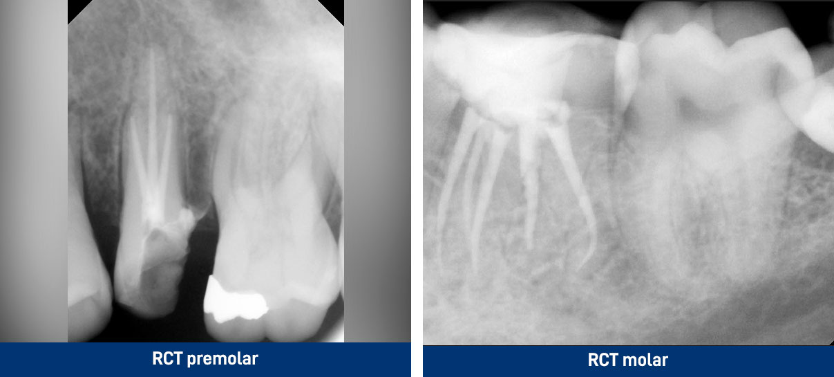 Root Canal treatment