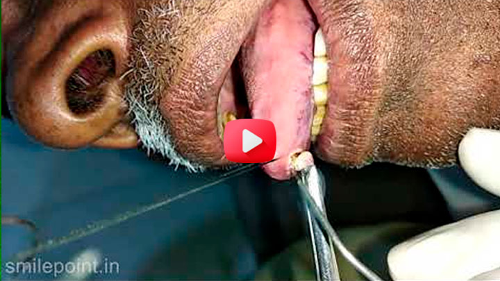 Laser treatment - Traumatic fibroma excision