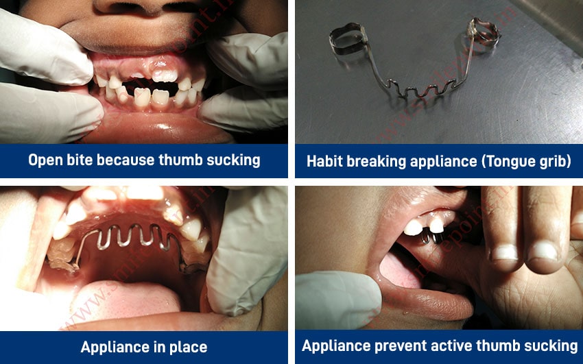 Child Care Dentistry