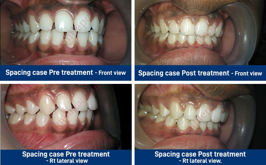 Teeth Alignment
